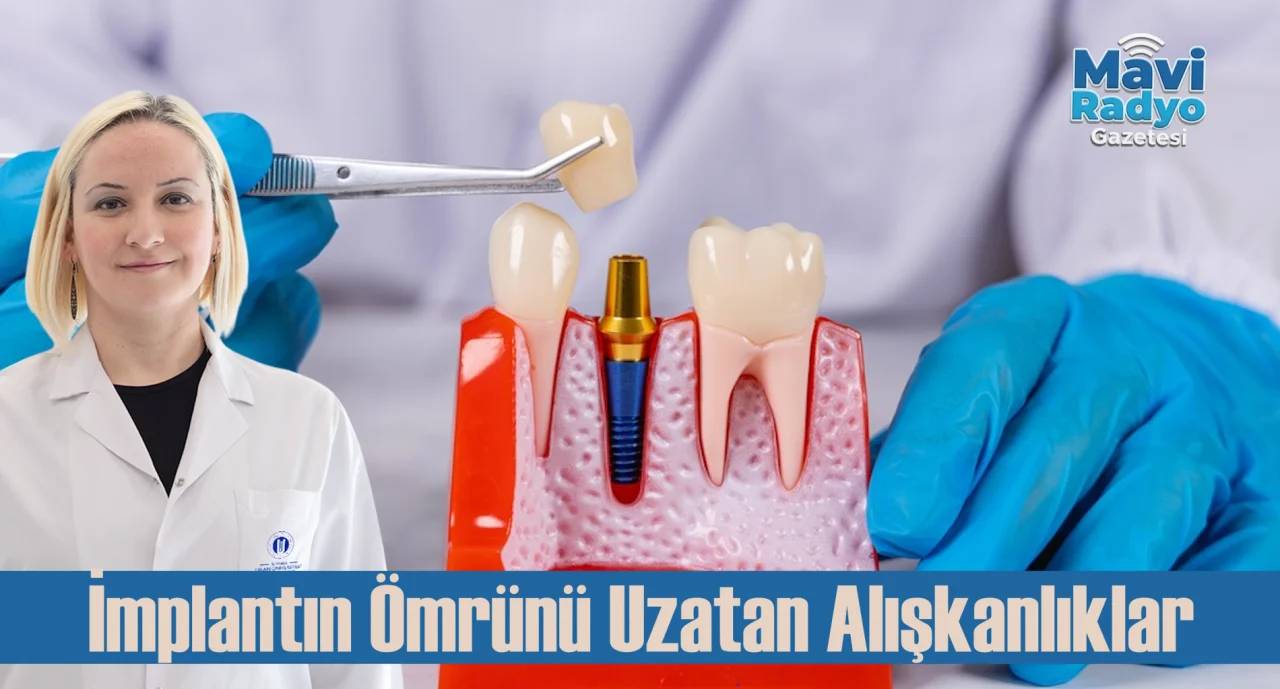 İmplantın Ömrünü Uzatan Alışkanlıklar 